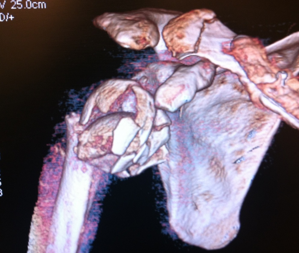 Proximal Humerus Unreconstructable